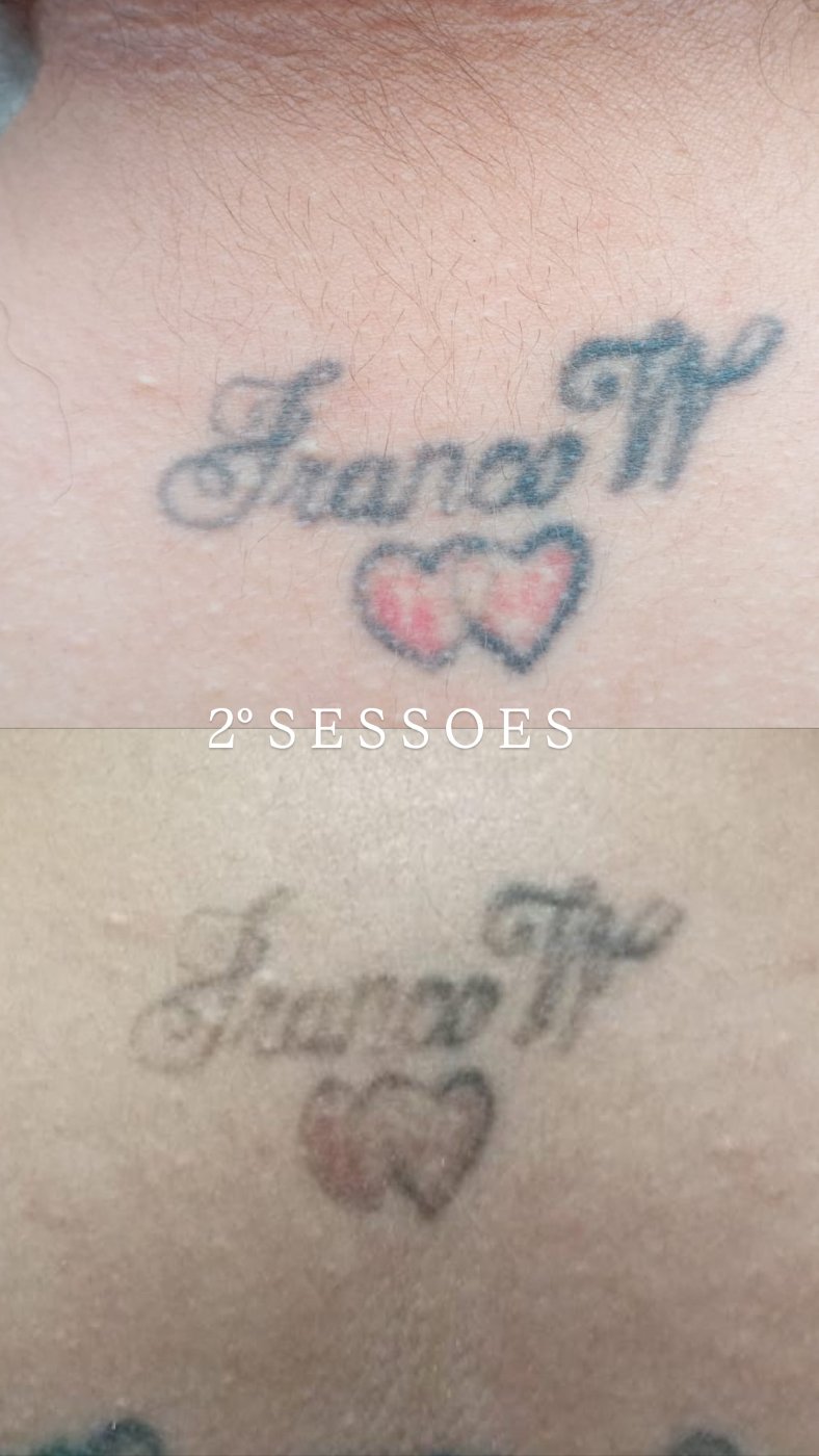 Antes e depois de remoção de tatuagem a laser em Araçatuba — caso 1